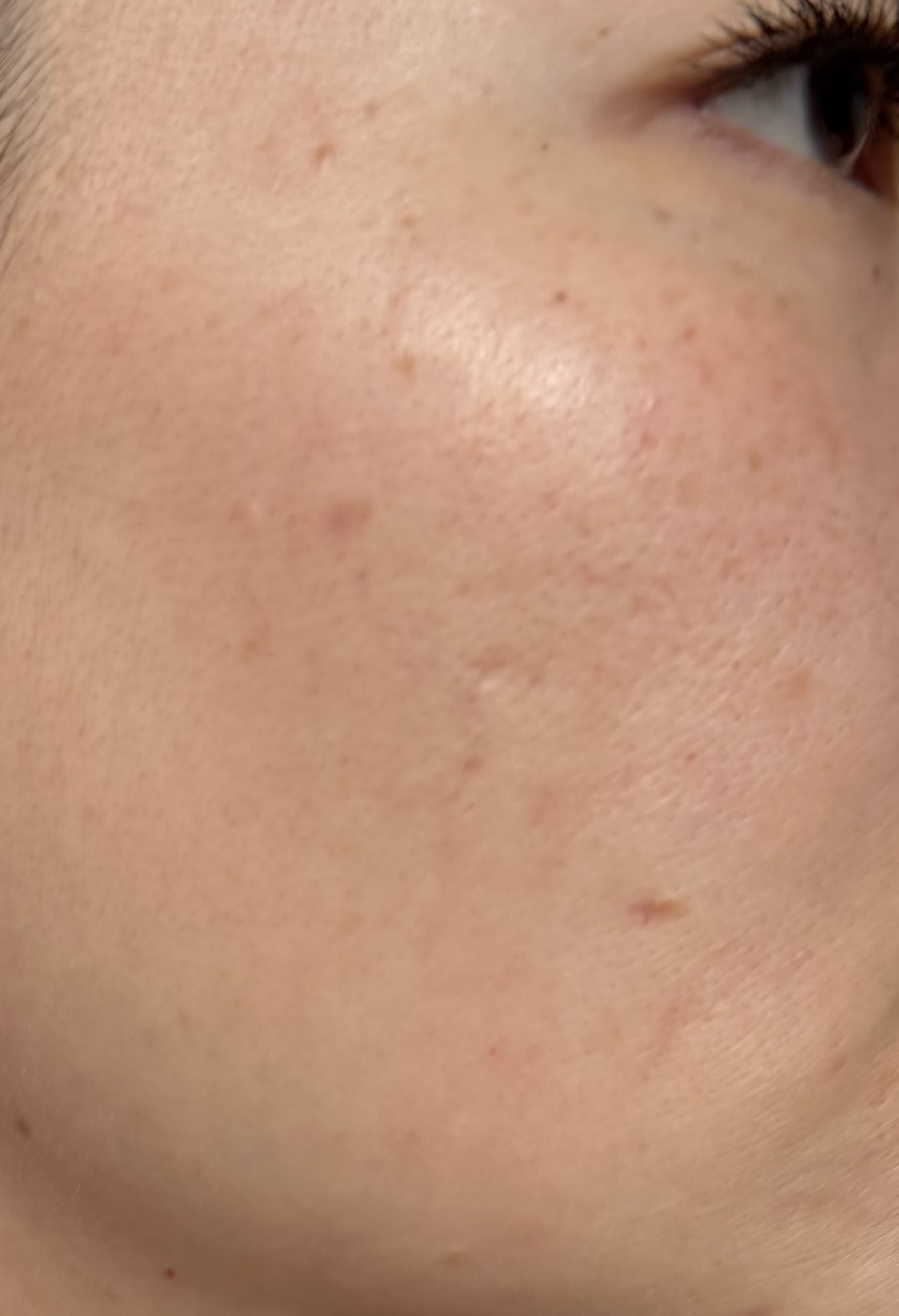Skin before routine, showing acne marks and redness
